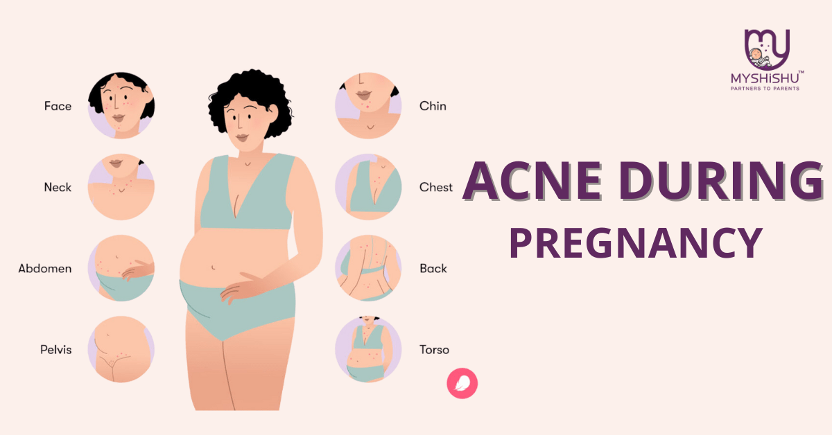 View of Acne during Pregnancy: The Ultimate Guide of Remedy - MyShishu