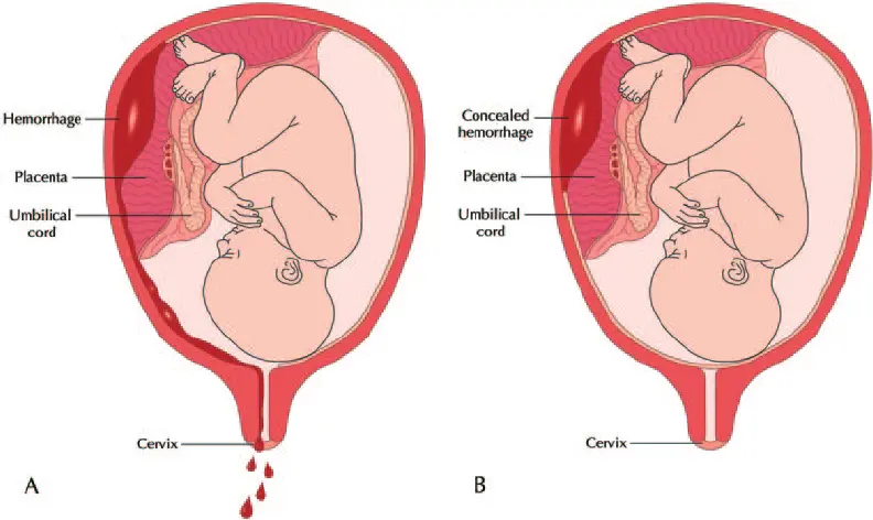 Placental abruption during pregnancy